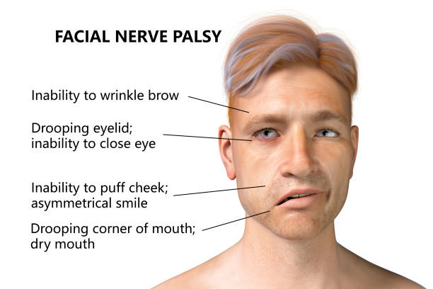 Facial nerve paralysis, Bell's palsy Facial nerve paralysis, Bell's palsy, 3D illustration showing male with one-sided facial nerve paralysis bell's palsy stock pictures, royalty-free photos & images