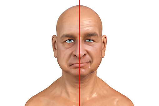 Facial nerve paralysis, Bell's palsy, 3D illustration showing male with one-sided facial nerve paralysis
