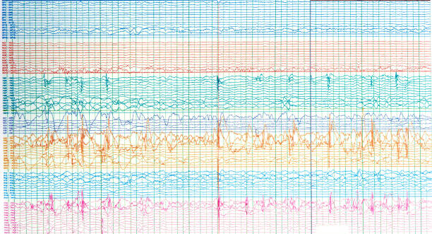 Photography of brain waves of epilepsy patient Photography of human electroencephalograhy of epileptic patient showing sharp wave during  no seizure or interictal EEG. eeg stock pictures, royalty-free photos & images
