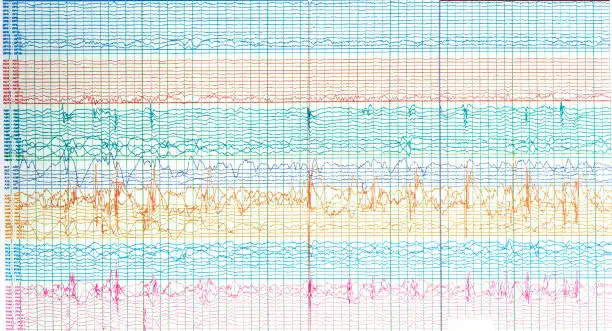 Photography of human electroencephalograhy of epileptic patient showing sharp wave during  no seizure or interictal EEG.