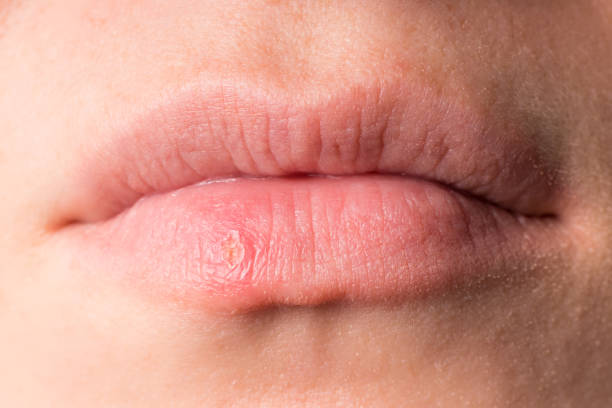 istock Skin disease on the lips. Herpes virus infection. 1319656480