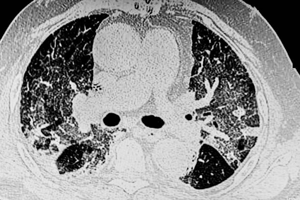 istock Chest CT Scan of Novel Coronavirus COVID-19 1319668946