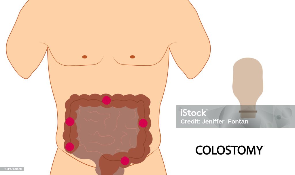 Colostomie Illustration Der Colostomie Tasche Positionierung Stock