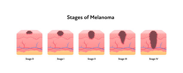 Melanoma cancer anatomical infographic poster. Vector flat medical illustration. Stages of tumor disease. Design for healthcare, oncology, dermatology. Melanoma cancer anatomical infographic poster. Vector flat medical illustration. Stages of tumor disease. Design for healthcare, oncology, dermatology. melanoma stock illustrations