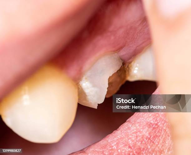 Composite Filling Tooth Treatment Stock Photo - Download Image Now - Bone  Fracture, Broken, Care - iStock