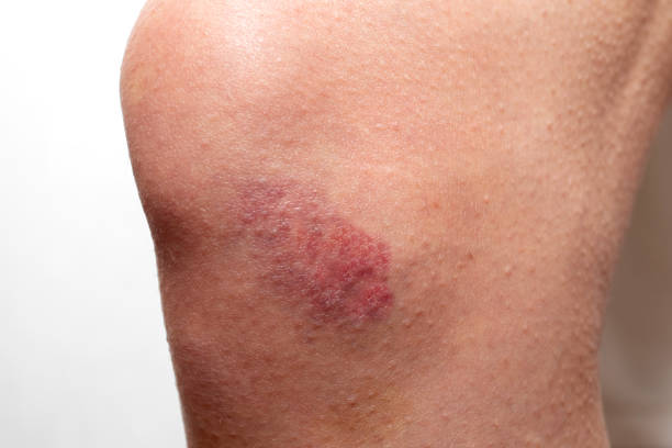 istock Big red bruise on the knee. Injured knee joint. Hematoma. 1320004010
