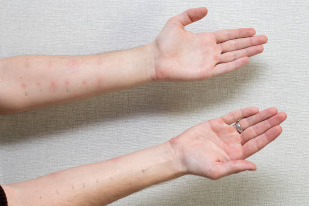 istock Male hands with positive allergy tests. Allergy tests on the arms 1320006385