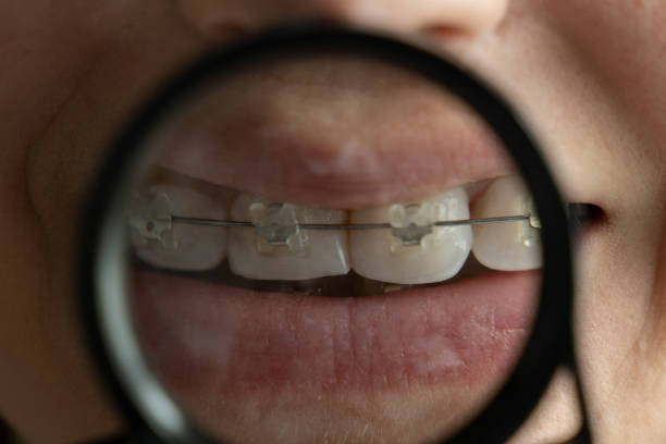 istock Woman showing her braces in magnifying glass 1320007960