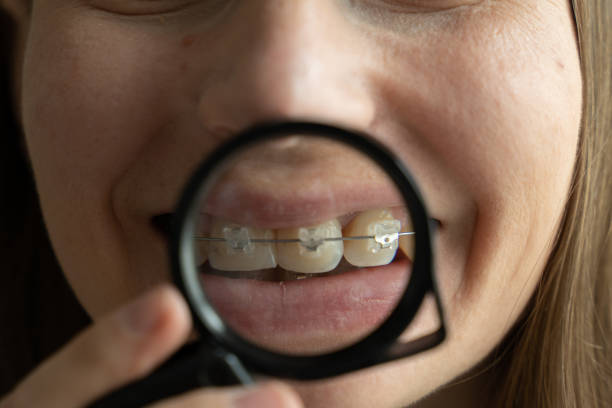 istock Woman showing her braces in magnifying glass 1320008251