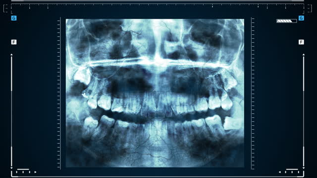 X-ray of human teeth or research on dental health. The doctor examines the patient's jaw, treats the tooth.