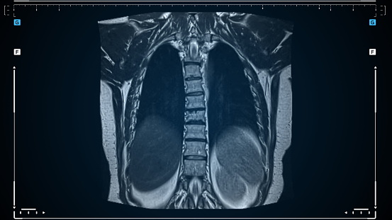 MRI lung scan, magnetic resonance imaging of a back and skeleton close-up. Diagnosis of viral or covid-19 respiratory disease. CT scan animation of the results