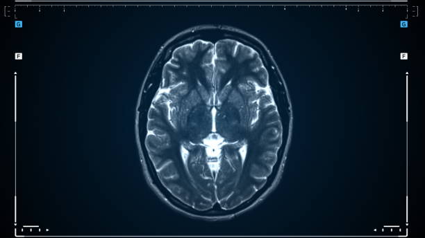 scansione della risonanza magnetica cerebrale. scansione dell'immagine di risonanza magnetica del cervello. strumento medico diagnostico. - mri scan human nervous system brain medical scan foto e immagini stock