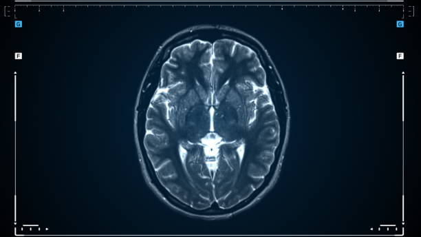 뇌 mri 스캔. 뇌의 자기 공명 이미지 스캔. 진단 의료 도구. - mri 스캔 뉴스 사진 이미지