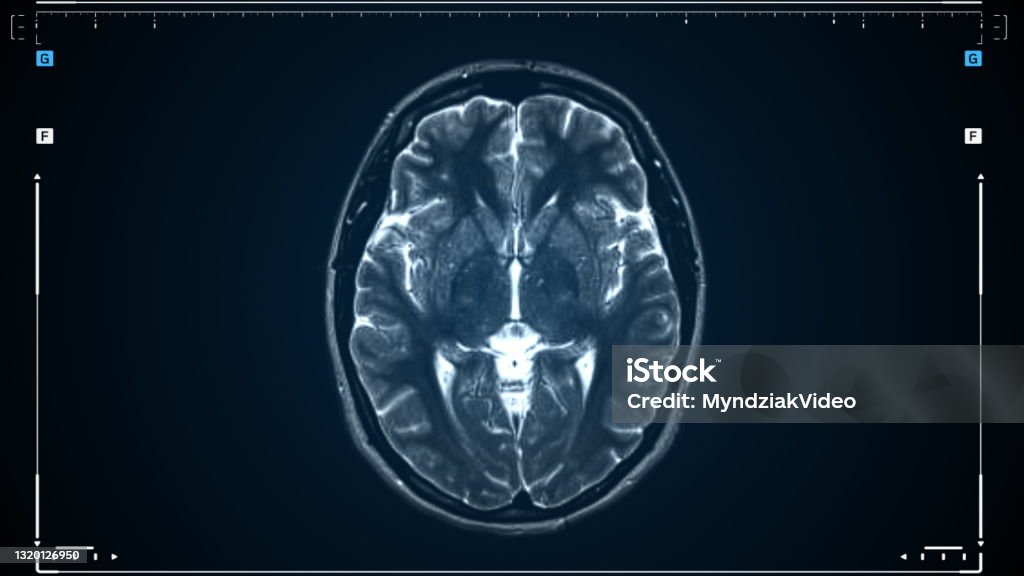 Brain MRI scan. Scanning of brain's magnetic resonance image. Diagnostic Medical Tool. Brain MRI scan. Scanning of brain's magnetic resonance image. Diagnostic Medical Tool MRI Scan Stock Photo