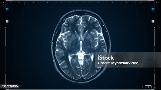 Brain Mri Scan Scanning Of Brains Magnetic Resonance Image Diagnostic Medical Tool Stock Photo - Download Image Now