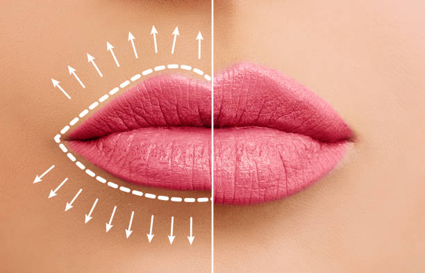 lippenvergrößerungskonzept. frauenlippen vor und nach lippenfüller injektionen - big lips stock-fotos und bilder