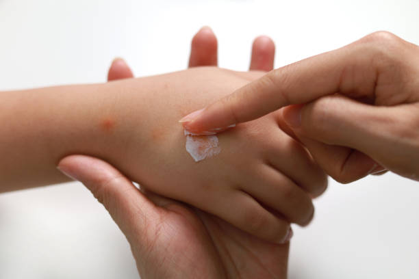 madre aplicando crema antialérgica en la mano de su hijo causa por picaduras de mosquitos de cerca. - malaysian person family asian ethnicity mother fotografías e imágenes de stock