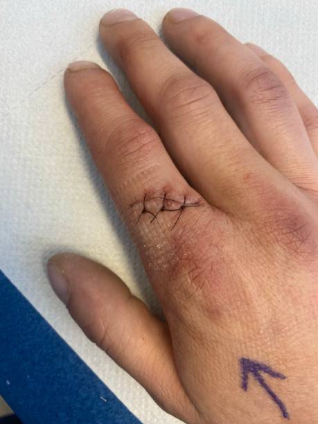 istock Finger Injury with stitches 1320234037