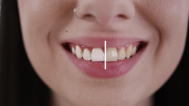SLO MO Teeth of a smiling young caucasian woman being whitening