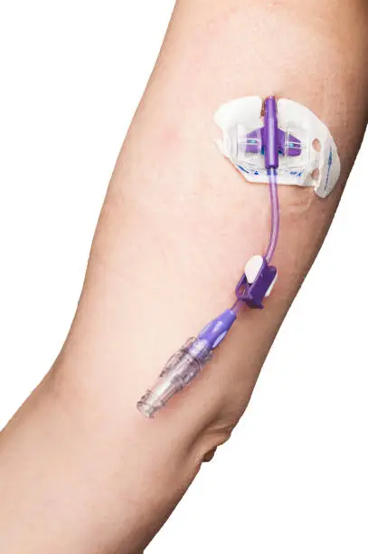 Photo of PICC line on the arm of a woman undergoing chemotherapy for breast cancer isolated on white background
