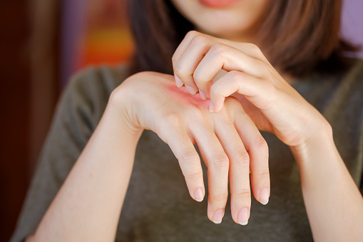 La mujer asiática se rasca una mano con una erupción roja en la parte posterior de la mano debido a una alergia corporal extranjera o picadura de insecto. photo