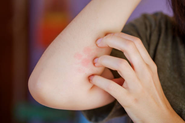 woman is scratching arm A woman is scratching a red blistered arm due to a foreign body intolerance or an insect bite. bug bite photos stock pictures, royalty-free photos & images