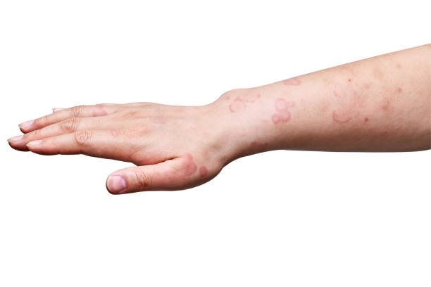 istock chronic urticaria symptoms on the male arm 1320458807