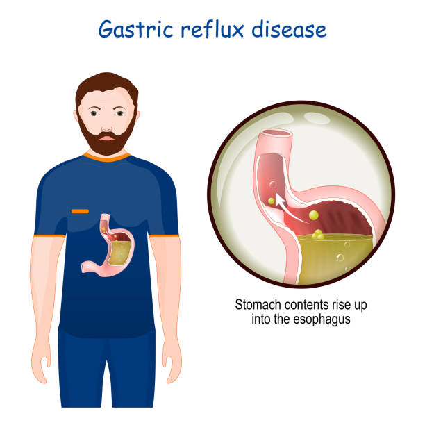 Gastroesophageal reflux disease Gastroesophageal reflux disease. Close-up of stomach with GERD. chronic condition in which stomach contents rise up into the esophagus. human anatomy. vector illustration sphincter stock illustrations