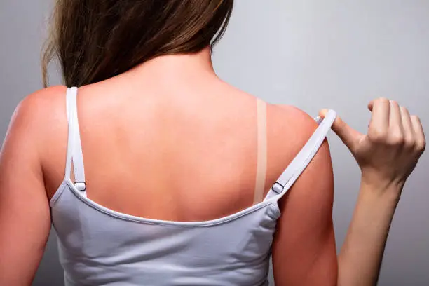 Woman with sunburn on back and shoulders
