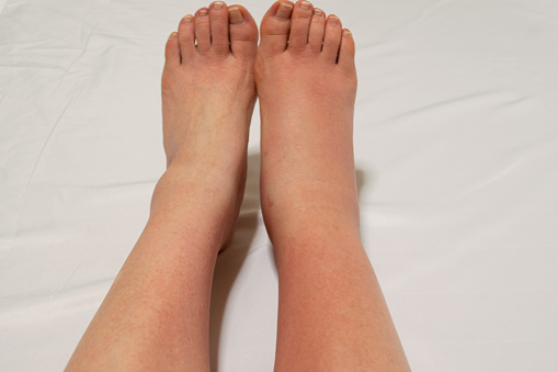 One of the leg with the early symptom of bacterial cellulitis, which is developing edema red skin and is also causing itching sensation and pain.