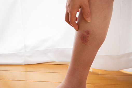 Una pierna con el síntoma de la celulitis bacteriana photo