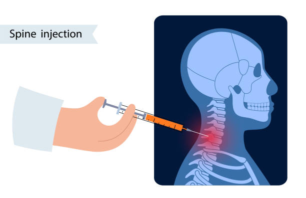 ภาพประกอบสต็อกที่เกี่ยวกับ “การฉีดกระดูกสันหลัง - puncturing”