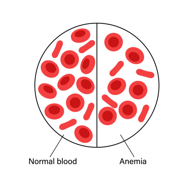 Blood structure concept Normal blood and specimen with anemia disease. Human blood cells structure. Thrombocytes, leukocytes and erythrocytes under microscope. Microbiology test flat vector illustration for clinic, education anemia diagram stock illustrations