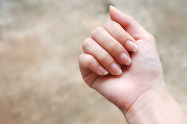 女性の爪の白い斑点, カルシウム欠乏症によって引き起こされる健康について明らかに.この病気はロイコニキアと呼ばれています。 - 手の爪 ストックフォトと画像