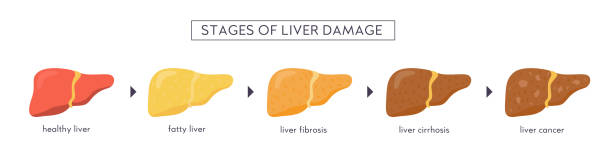 Stages of nonalcoholic liver damage. Healthy, fatty, steatosis, NASH, fibrosis, cirrhosis, cancer. Medical infographic of Liver Disease. Vector banner in flat cartoon style on white background. Stages of nonalcoholic liver damage. Healthy, fatty, steatosis, NASH, fibrosis, cirrhosis, cancer. Medical infographic of Liver Disease. Vector banner in flat cartoon style on white background liver failure stock illustrations