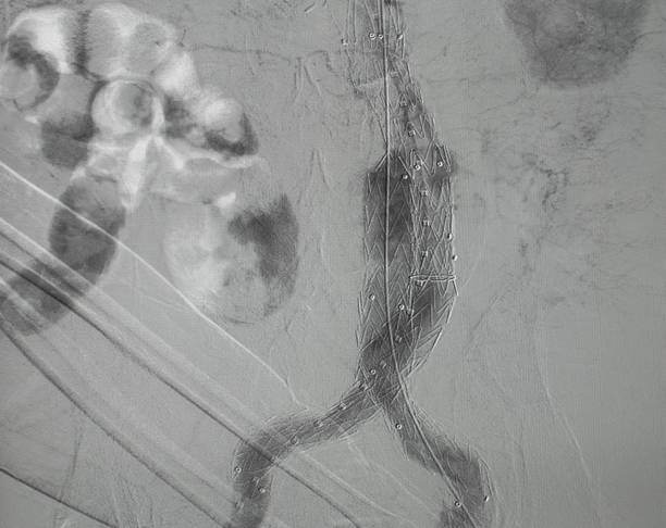 istock x-ray image. Angiogram of right common iliac artery after aortic stent graft deployed at infra renal abdominal aortic aneurysm during EVAR 1320943574