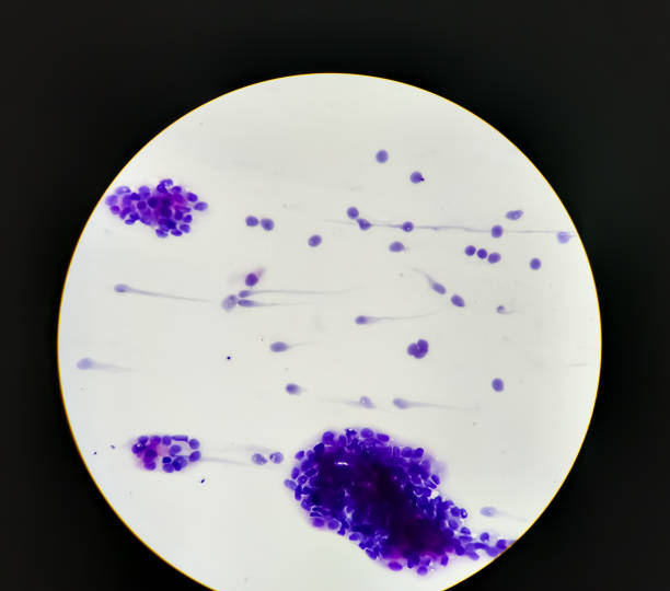 istock Pleural fluid adenocarcinoma 1321050301