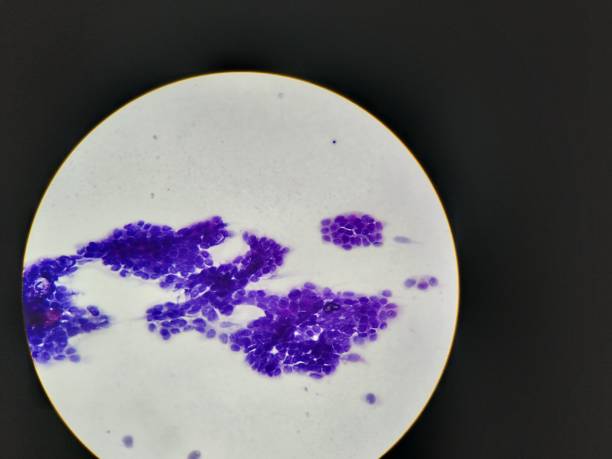 istock Pleural fluid adenocarcinoma 1321050317