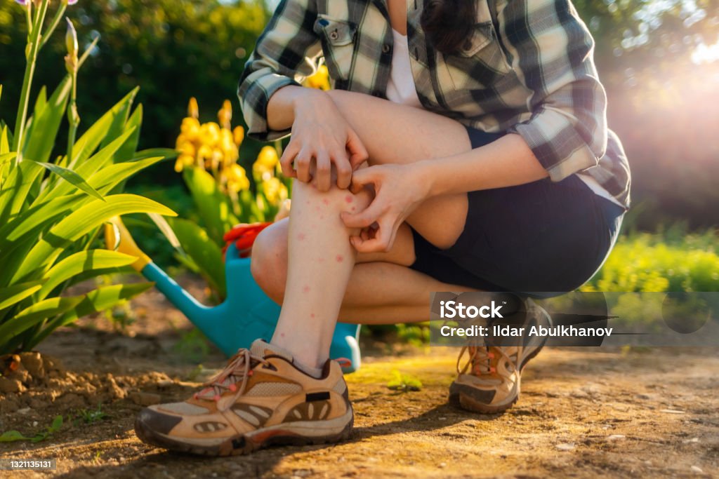 Allergies and insect bites concept. Person scratches her legs, which is itchy from a mosquito bite. Close up. Summer garden on the background Allergies and insect bites concept. Person scratches her legs, which is itchy from a mosquito bite. Close up. Summer garden on the background. Mosquito Stock Photo