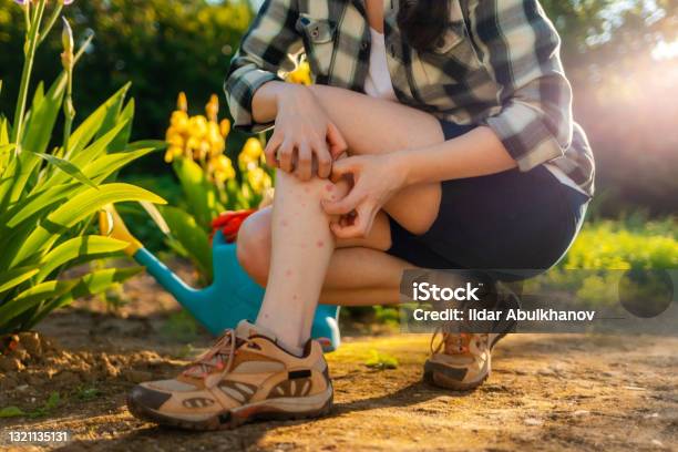 Allergies And Insect Bites Concept Person Scratches Her Legs Which Is Itchy From A Mosquito Bite Close Up Summer Garden On The Background Stock Photo - Download Image Now