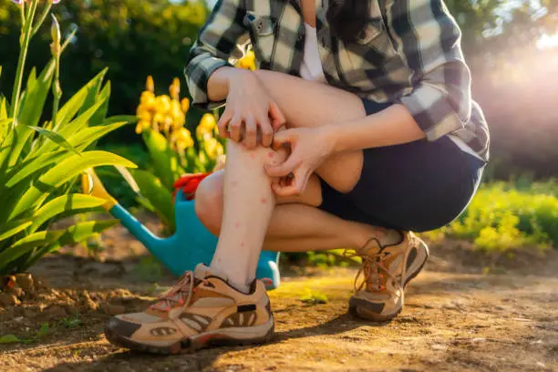 Photo of Allergies and insect bites concept. Person scratches her legs, which is itchy from a mosquito bite. Close up. Summer garden on the background