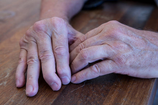 나무 테이블에 건선 관절염을 가진 남자의 손. - arthritis 뉴스 사진 이미지
