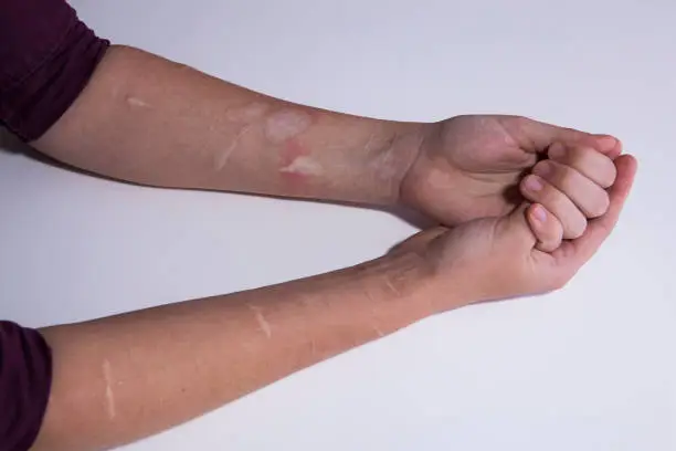 Photo of The arms of a young woman who practiced self-harm.