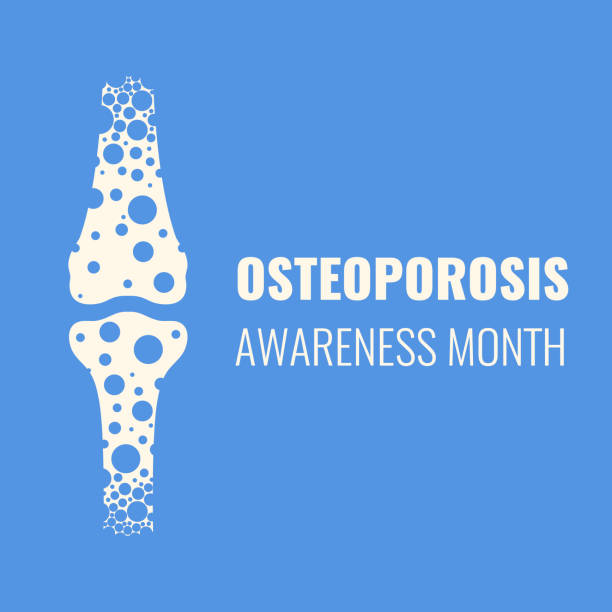 Osteoporosis disease awareness poster of a porous bone World osteoporosis awareness month. Porous femur conceptual vector illustration. Loss of bone mass, hip fractures and broken bones prevention. Skeletal system disease. Senior osteopathy. osteoporosis awareness stock illustrations