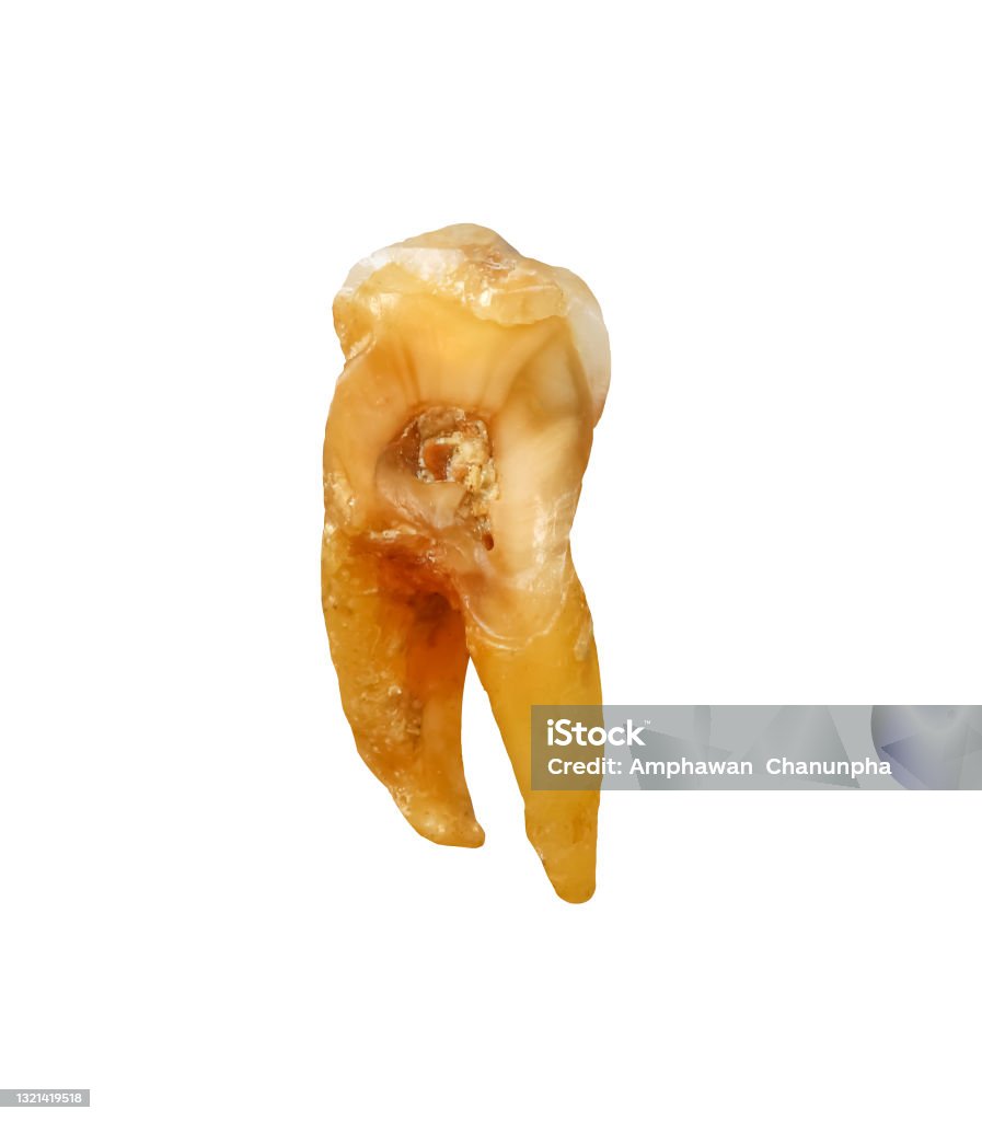 Single Tooth Real Single Human Tooth With Caries Isolated On White Background Clipping ...