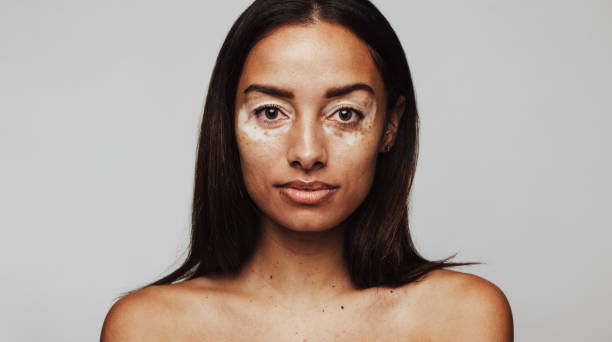 istock There is beauty in unique skin. 1321677990