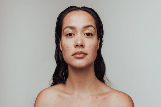 istock Portrait of woman having skin problems 1321678628