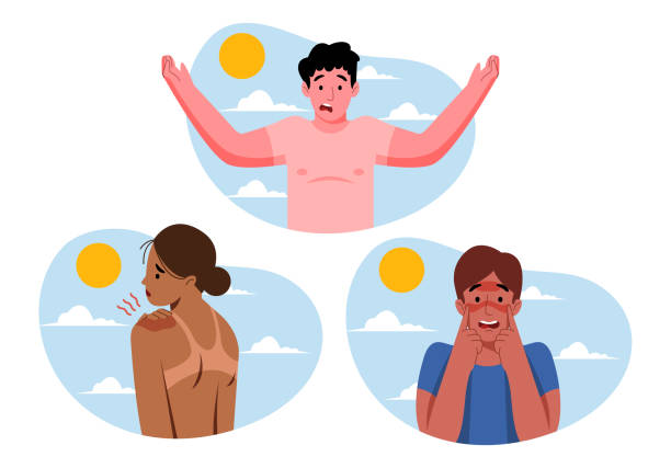 ilustraciones, imágenes clip art, dibujos animados e iconos de stock de grupo de diferentes personas con una ilustración vectorial de quemaduras solares - quemado por el sol