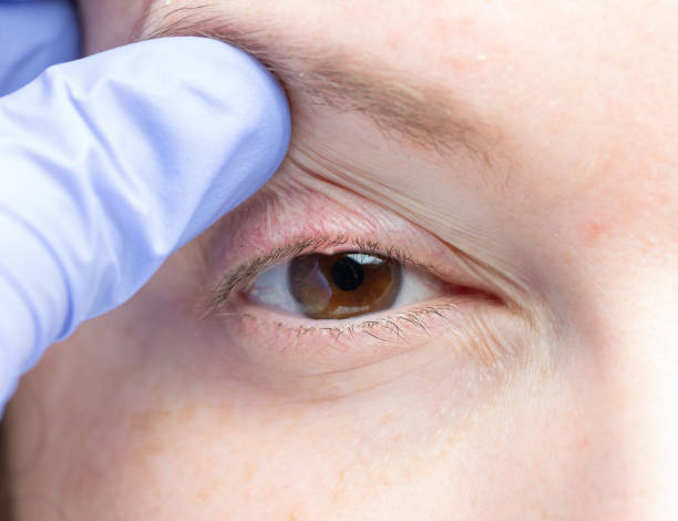 close up of a woman's eye with a bacterial infection close up of a woman's eye with a bacterial infection of an oil gland in the lower eyelid. life stile stock pictures, royalty-free photos & images