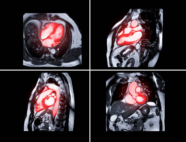 raccolta di risonanza magnetica mento-risonanza magnetica mento-risonanza magnetica della risonanza magnetica per la diagnosi di malattie cardiache. - aorta foto e immagini stock